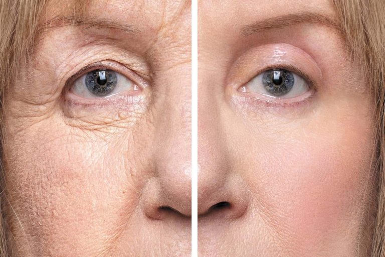 “You Look Tired”: Why Eyelid Surgery is Becoming the CEO’s Secret Weapon